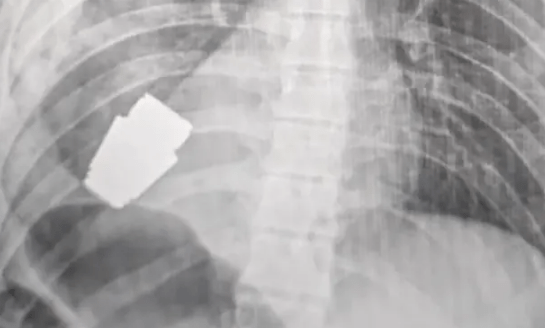 Mjekët nxjerrin granatën pa shpërthyer nga trupi i ushtarit ukrainas