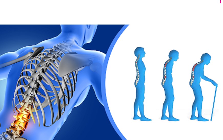 Diabeti ndikon në osteoporozë, zbuloni simptomat