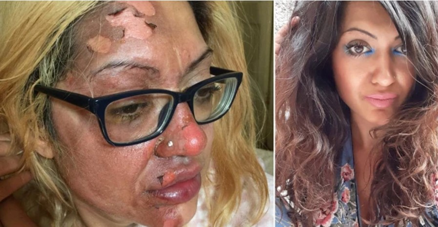 Zieu vezën me metodën që kishte mësuar në TikTok, 37-vjeçarja përjeton djegie të forta në fytyrë