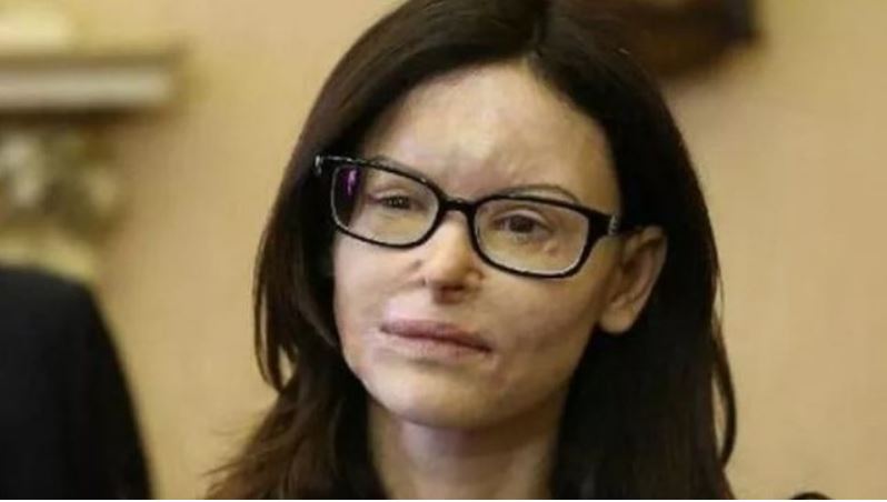 Lirohet pas 9 vitesh burg shqiptari që i hodhi acid në fytyrë deputetes italiane