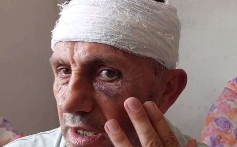 Konflikti në Krujë/ I plagosuri: Më goditën me tyta armësh, policia erdhi pas 2 orësh