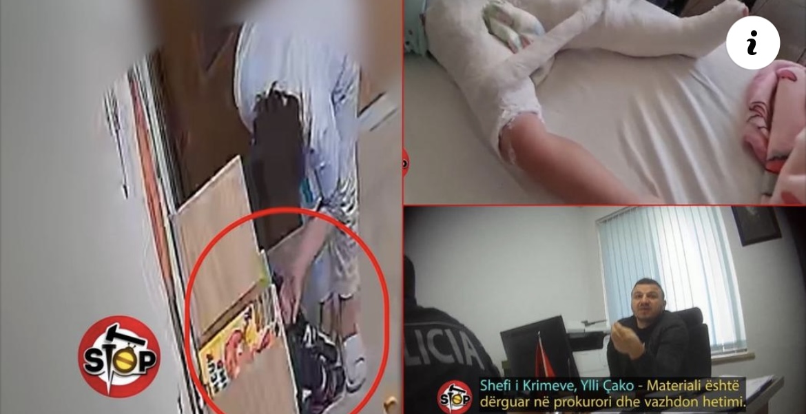 E tmerrshme! Edukatorja dhunon barbarisht 3-vjeçaren në kopshtin privat, e vogla dërgohet me këmbë të thyer në spital