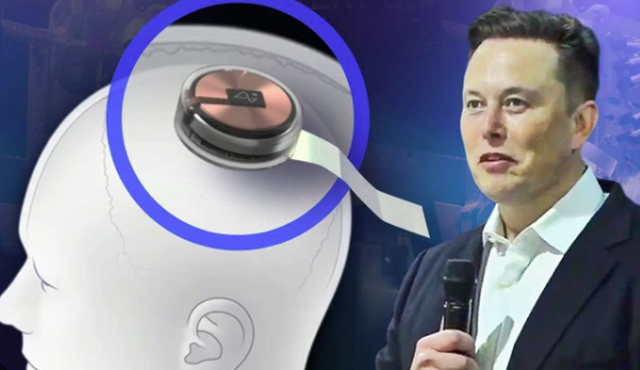 Elon Musk njofton vendosjen e çipit të parë &#8220;Neuralink&#8221; te një njeri