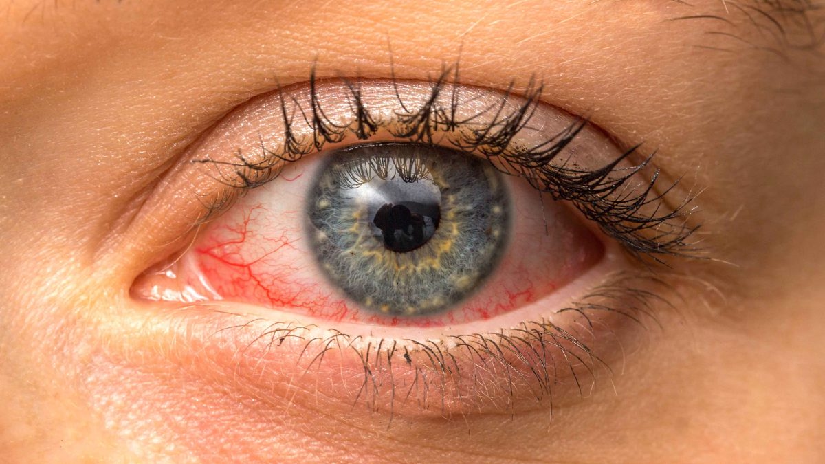 Tharja e syrit nga përdorimi i telefonit dhe kompjuterit, ja disa kura natyrale që ju ndihmojnë për këtë problem