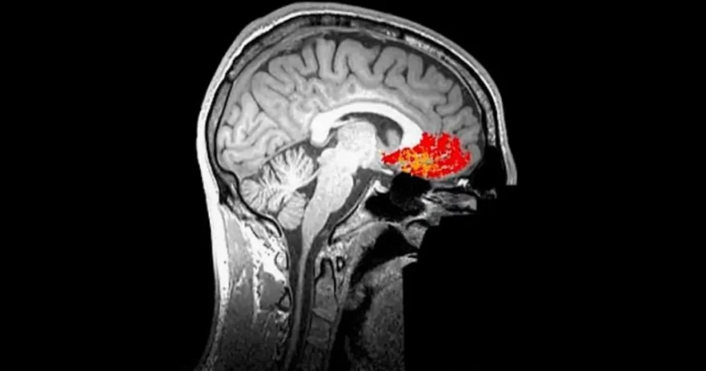 Inteligjenca Artificiale mund të dallojë anomalitë që shkaktojnë epilepsi