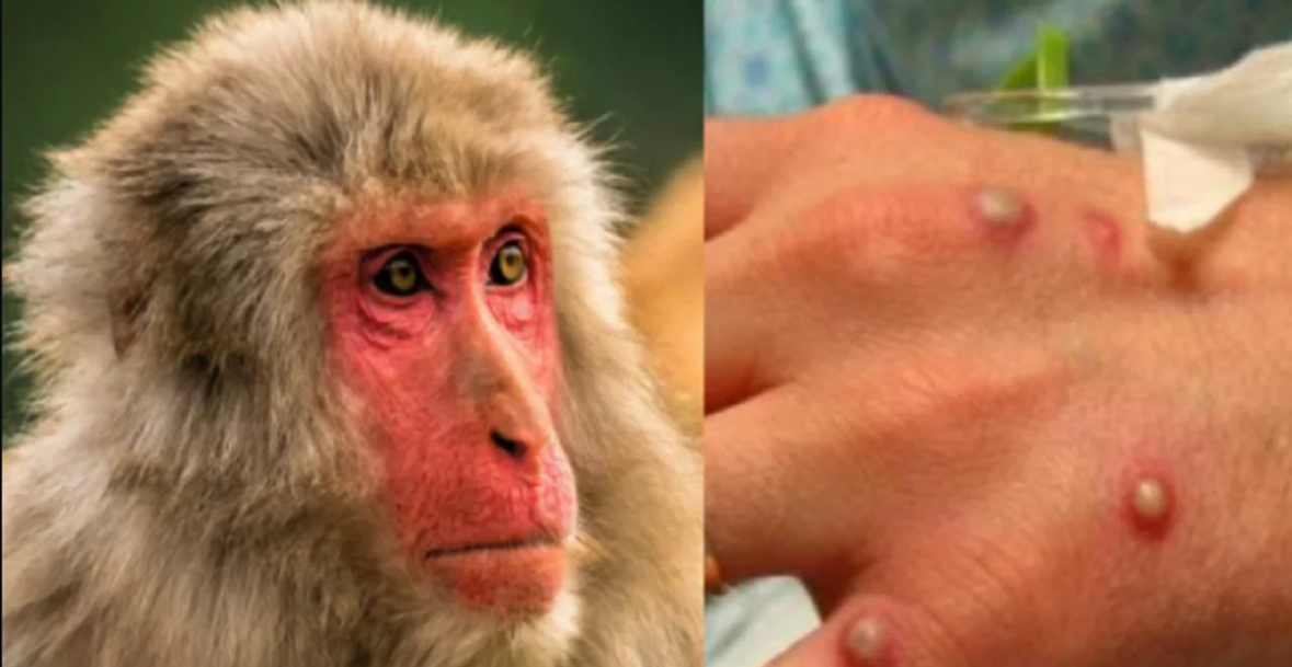 I pari në Shqipëri! Një 30-vjeçar rezulton i infektuar me lijën e majmunit 