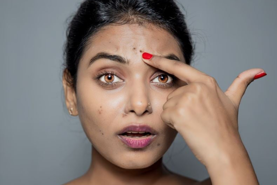 Thuajini lamtumirë njollave dhe pikave të errëta në lëkurë me një recetë të vjetër indiane!