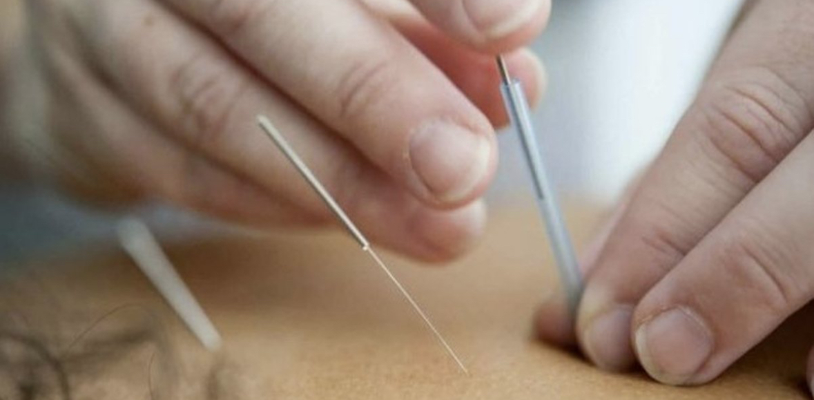 Çfarë thotë shkenca për akupunkturën dhe humbjen e peshës? 