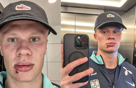 Haland dëmtohet te dera e autobusit, nuk shpëton pa qepje