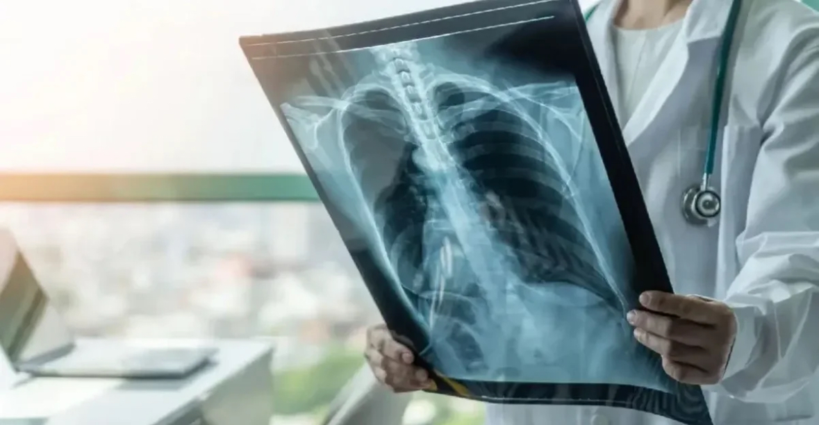 OBSH ngre alarmin: Tuberkulozi, sëmundja infektive më vdekjeprurëse në botë, shkaktoi 1.2 milion vdekje vetëm në vitin 2024 