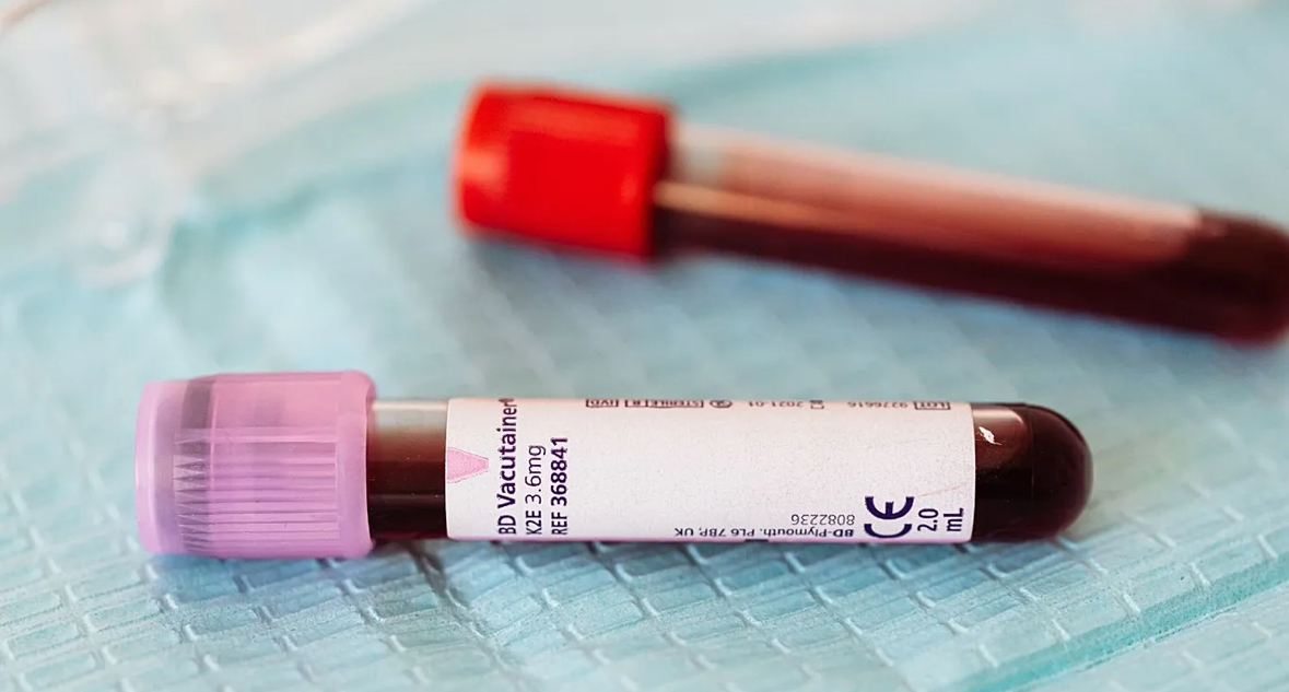 Etiopia konfirmon vdekjen e 3 personave nga virusi Marburg, alarm rajonal