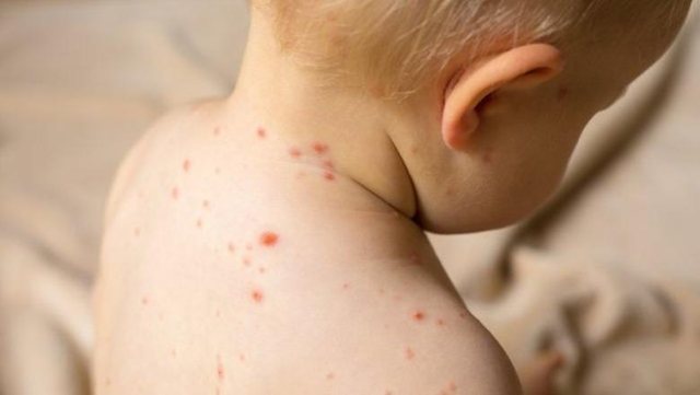 Erdhi nga Anglia dhe ishte i pavaksinuar! Konfirmohet rasti i parë i fruthit në Shqipëri, fëmija nën kujdesin e mjekëve