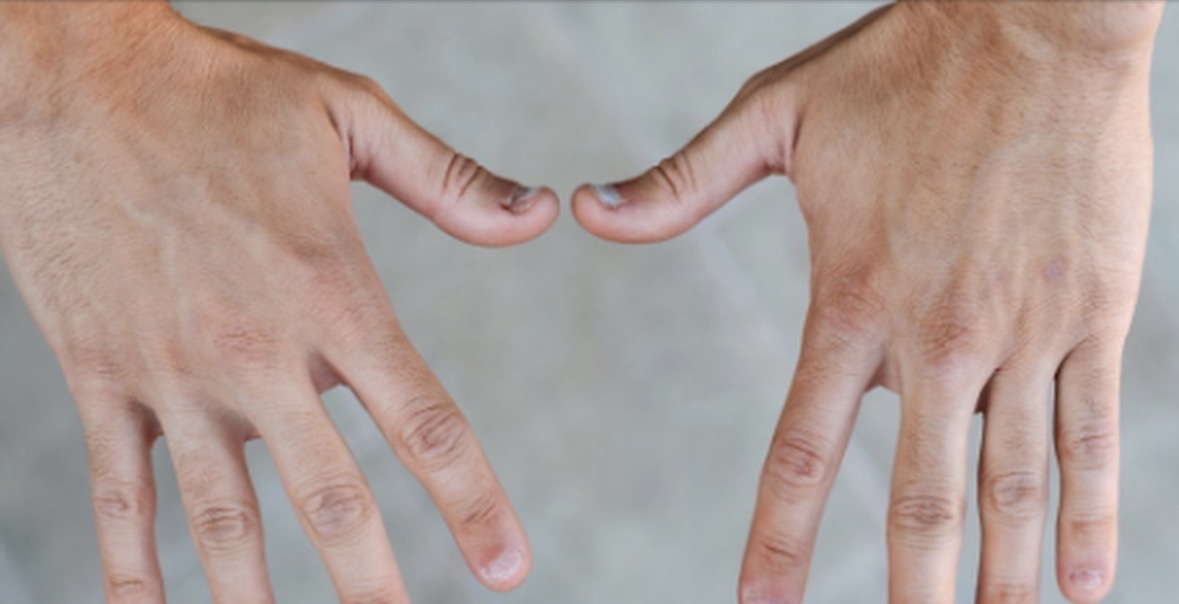 Pesë shenja që shfaqen në duart tuaja kur keni problem me tiroiden 