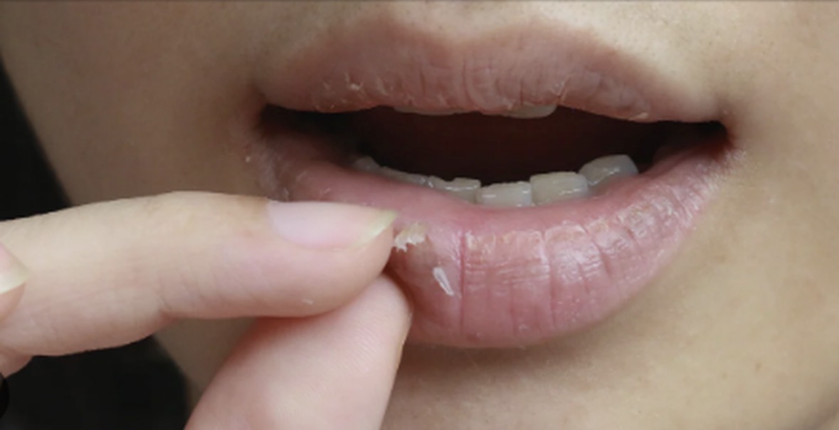 Çfarë të bëni kur ju plasariten buzët gjatë dimrit? 