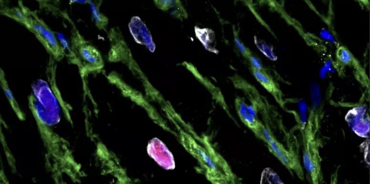 Studimi i Sidnejt: Zemra mund të rigjenerohet pjesërisht pas një infarkti 