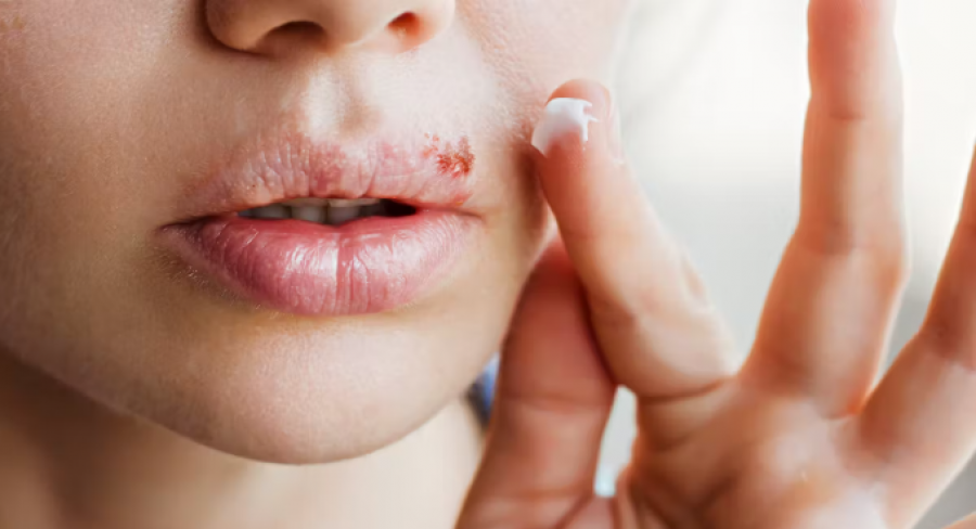 Rast shokues/ Fëmija humb syrin pasi u puth nga një i afërm me herpes, mjekët japin alarmin