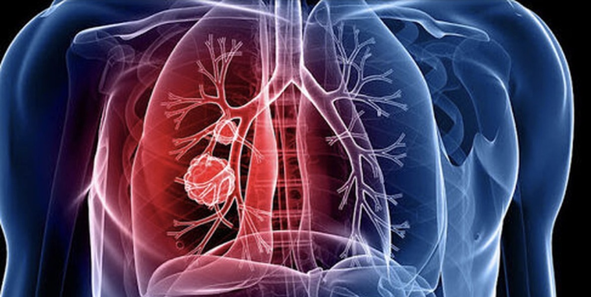 Raporti i OBSH: Tuberkulozi kërcënim serioz në Europë, 1 në 5 raste nuk raportohet 