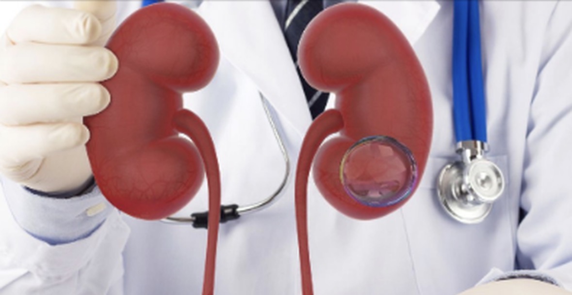 Kisti në veshka, kur është i padëmshëm dhe kur duhet të shqetësoheni 