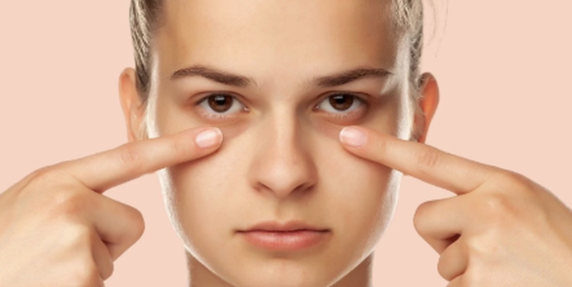 Rrathët nën sy/ Si t’i parandaloni dhe largoni nga fytyra juaj njëherë e përgjithmonë 