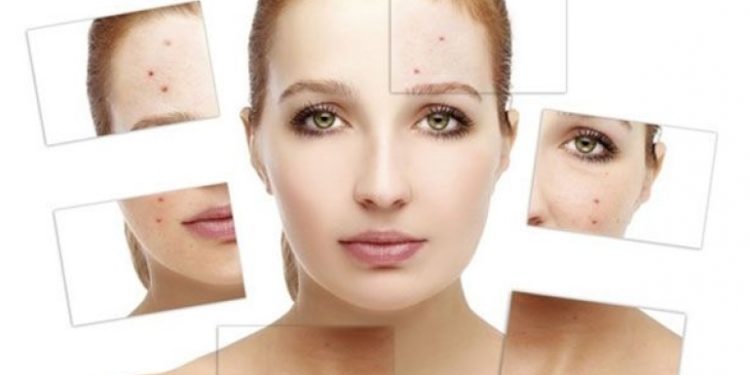 Çfarë domethënie kanë puçrrat në pjesë të caktuara të fytyrës?